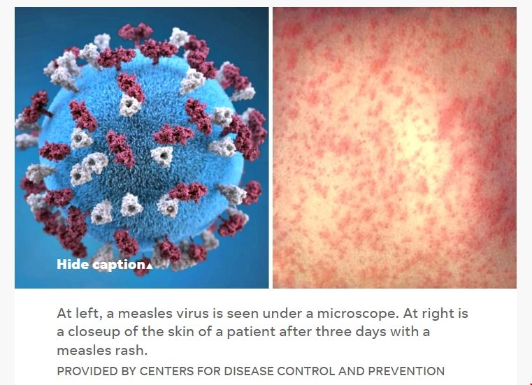 佐治亞大學聯合PSU研究出麻疹預測新模型.png 佐治亞大學聯合PSU研究出麻疹預測新模型.png