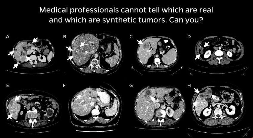 jhu研究員利用人工智能檢測(cè)早期癌癥.png jhu研究員利用人工智能檢測(cè)早期癌癥.png